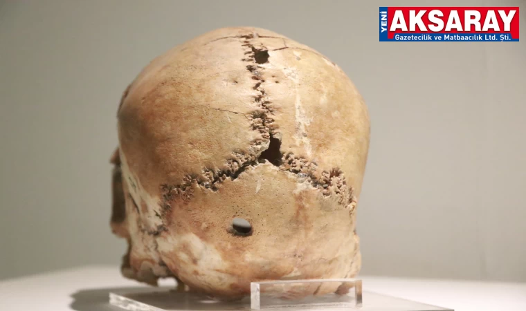 İlk beyin ameliyatına ait kafatası müzede sergileniyor